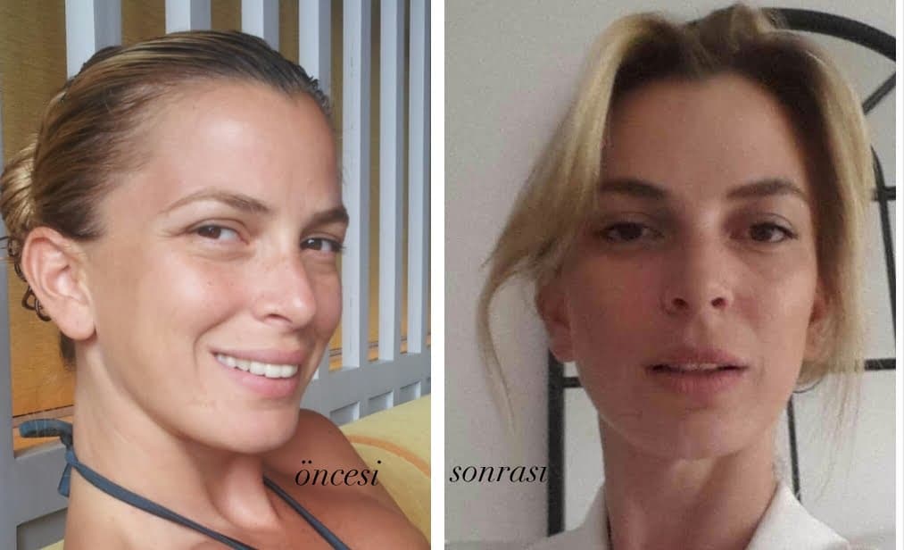 BOTOX’LUYKEN ASLA…