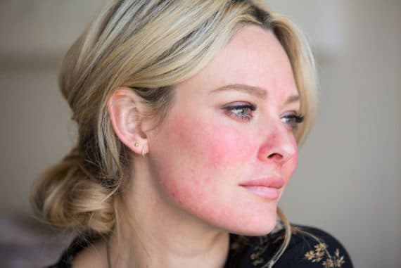 ROSACEA ‘’ GÜL HASTALIĞI’’ GERÇEKLERİ