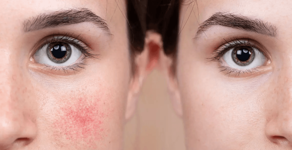 Bir Yaşayanın Kaleminden Rosacea ‘’Gül Hastalığı’’