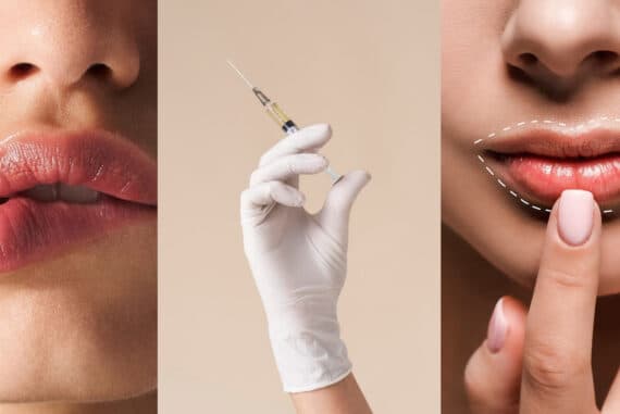 Medikal Estetikte Yeni Dönem: Biyostimülan yaklaşımla daha doğal dudaklar