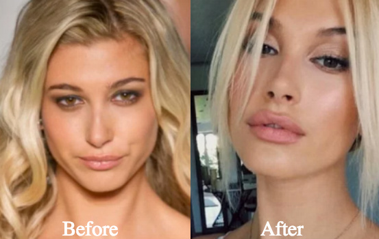 Hailey Bieber'ın öncesi ve sonrası yüz görünümünün zamanla değişimi