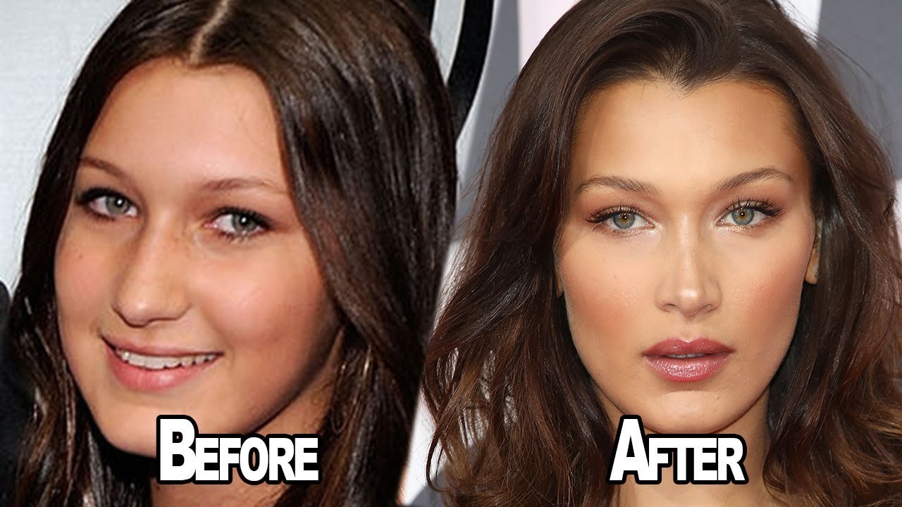 Bella Hadid'in önce ve sonra yüz görünümü karşılaştırması